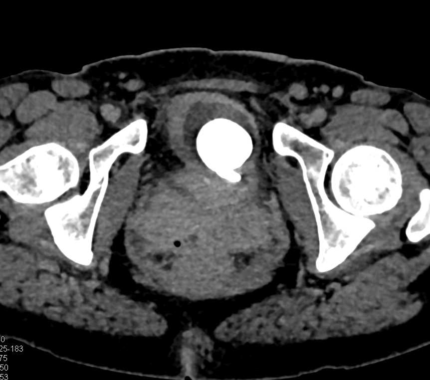 Calculi Left Kidney with Acute Pyelonephritis - CTisus CT Scan