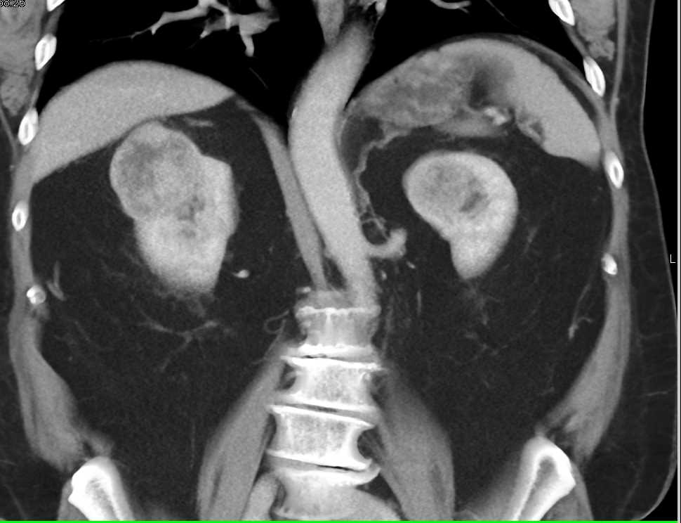 Bilateral Renal Cell Carcinomas - CTisus CT Scan