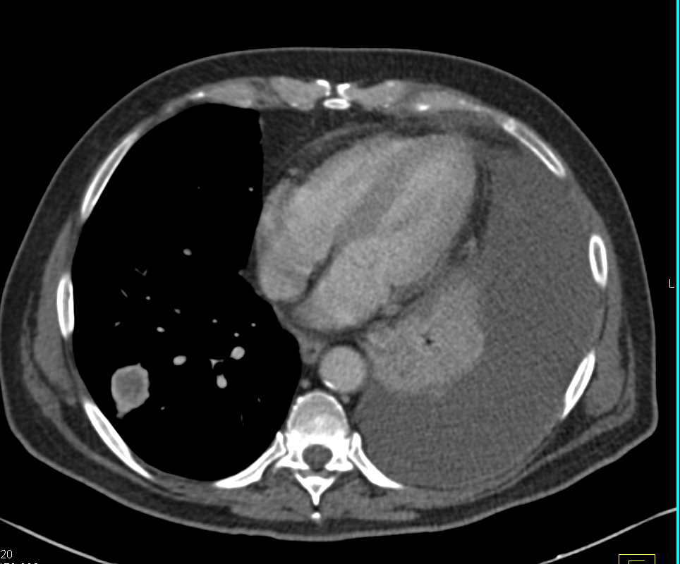 Metastatic Renal Cell Carcinoma to the Lung - CTisus CT Scan