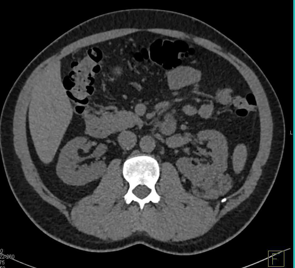Renal Angiomyolipoma - CTisus CT Scan