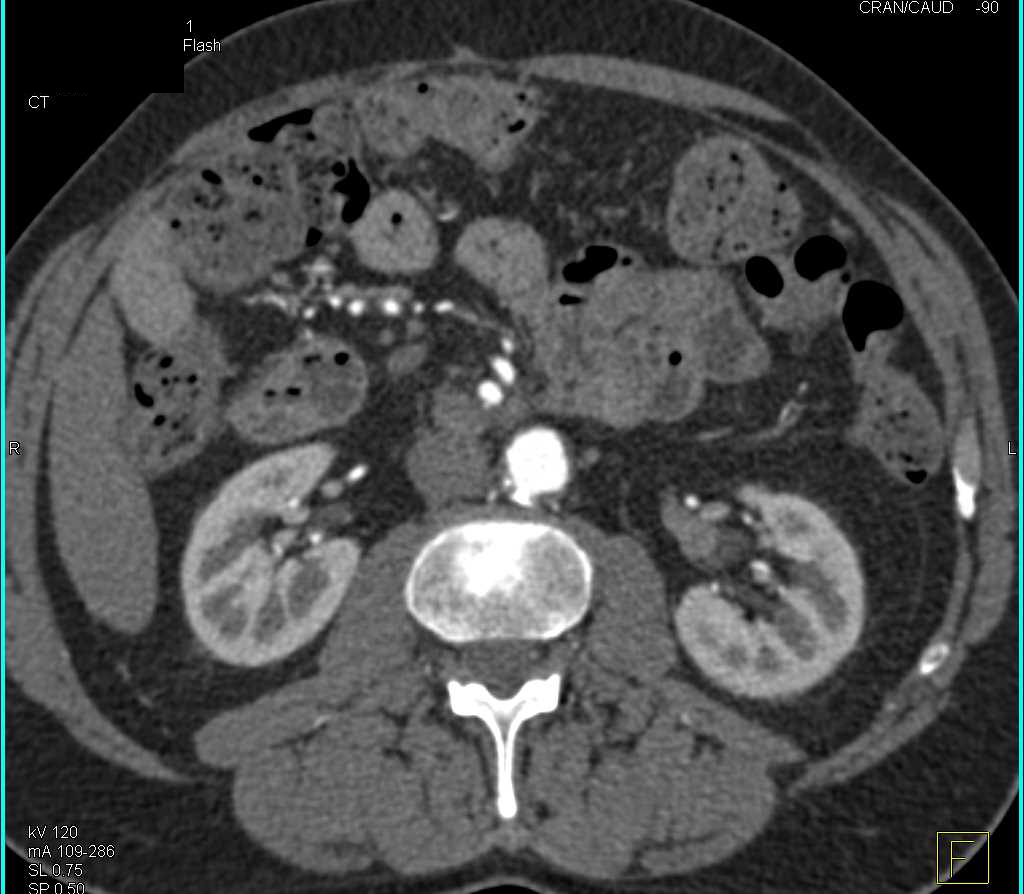 Transitional Cell Carcinoma Left Renal Pelvis - CTisus CT Scan