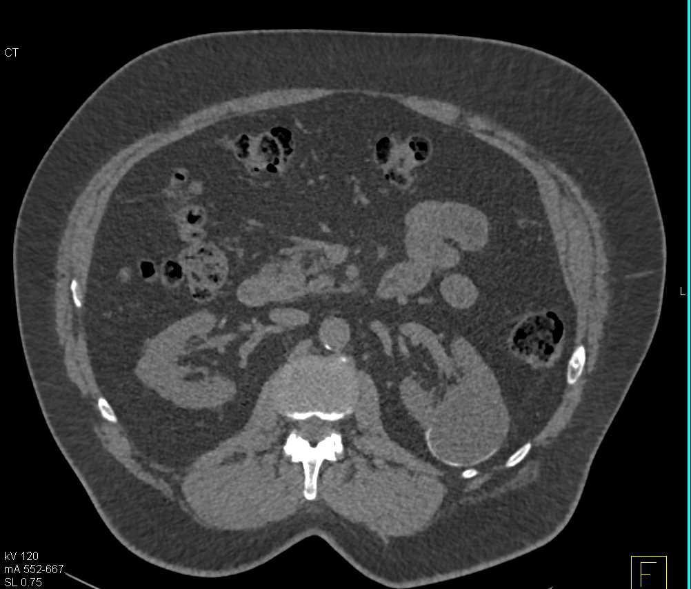 Bosniak 2F Cyst - CTisus CT Scan