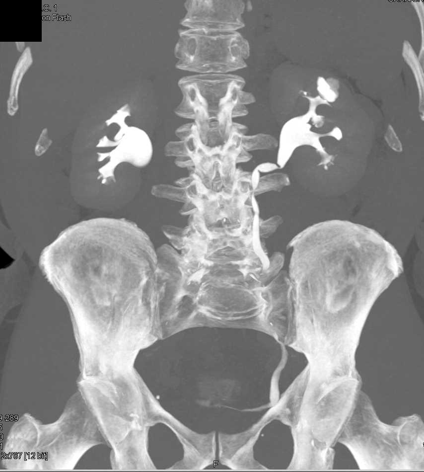 Calcifications in a Calyceal Diverticulum - CTisus CT Scan