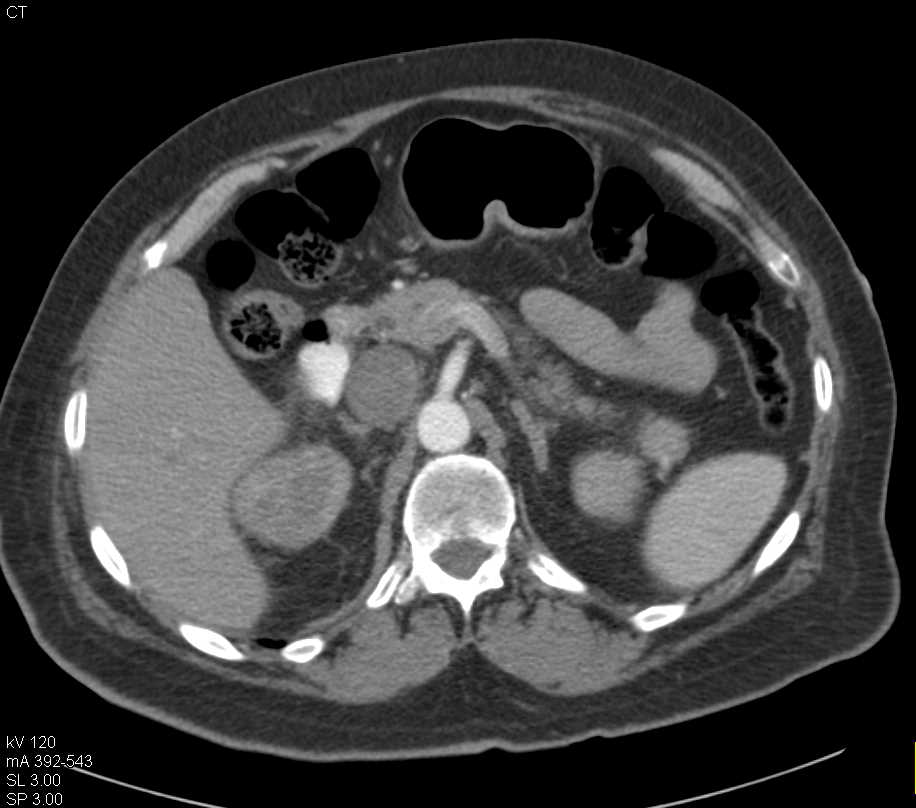 Infiltrating Transitional Cell Carcinoma Left Kidney - CTisus CT Scan