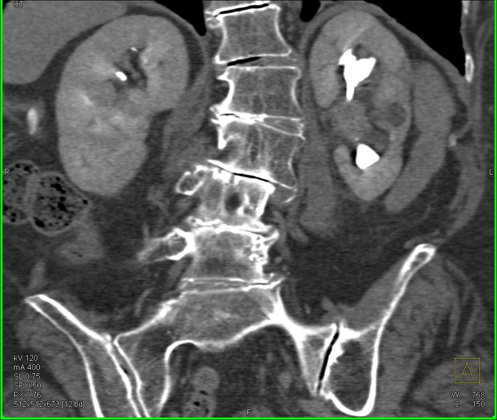 Transitional Cell Carcinoma Left Renal Pelvis - CTisus CT Scan