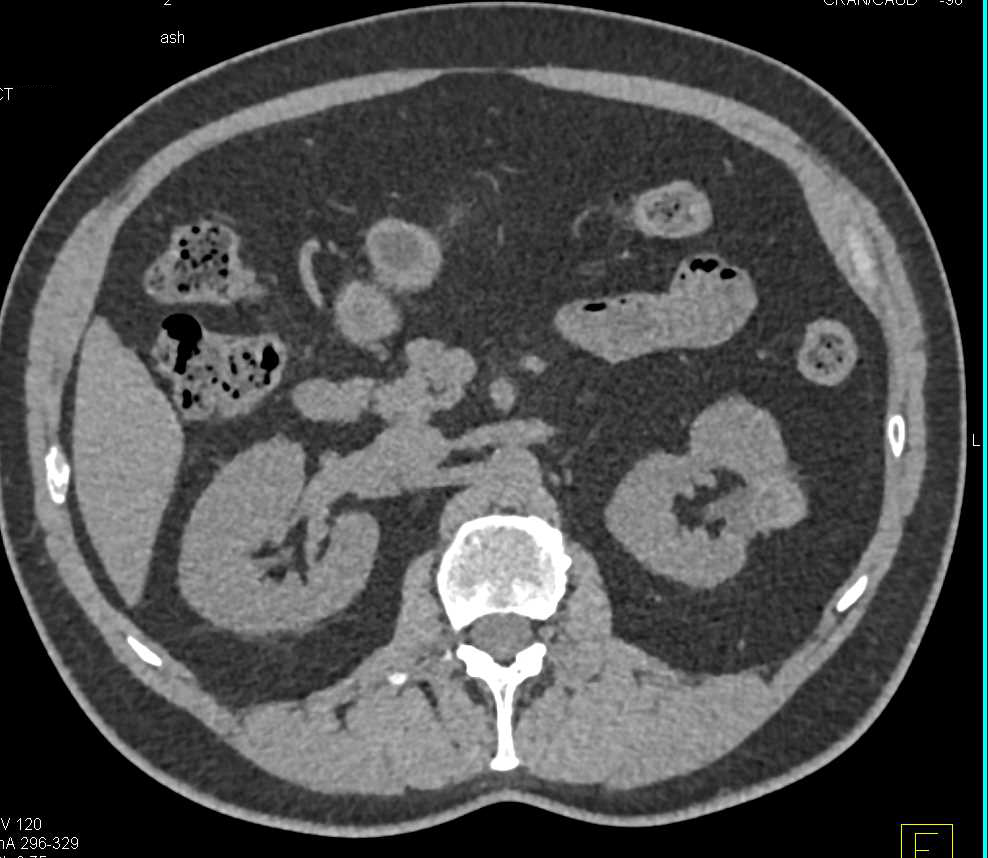 Post Cryoablation Changes Left Kidney - CTisus CT Scan