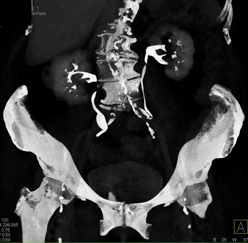 Incidental Renal Cell Carcinoma - CTisus CT Scan