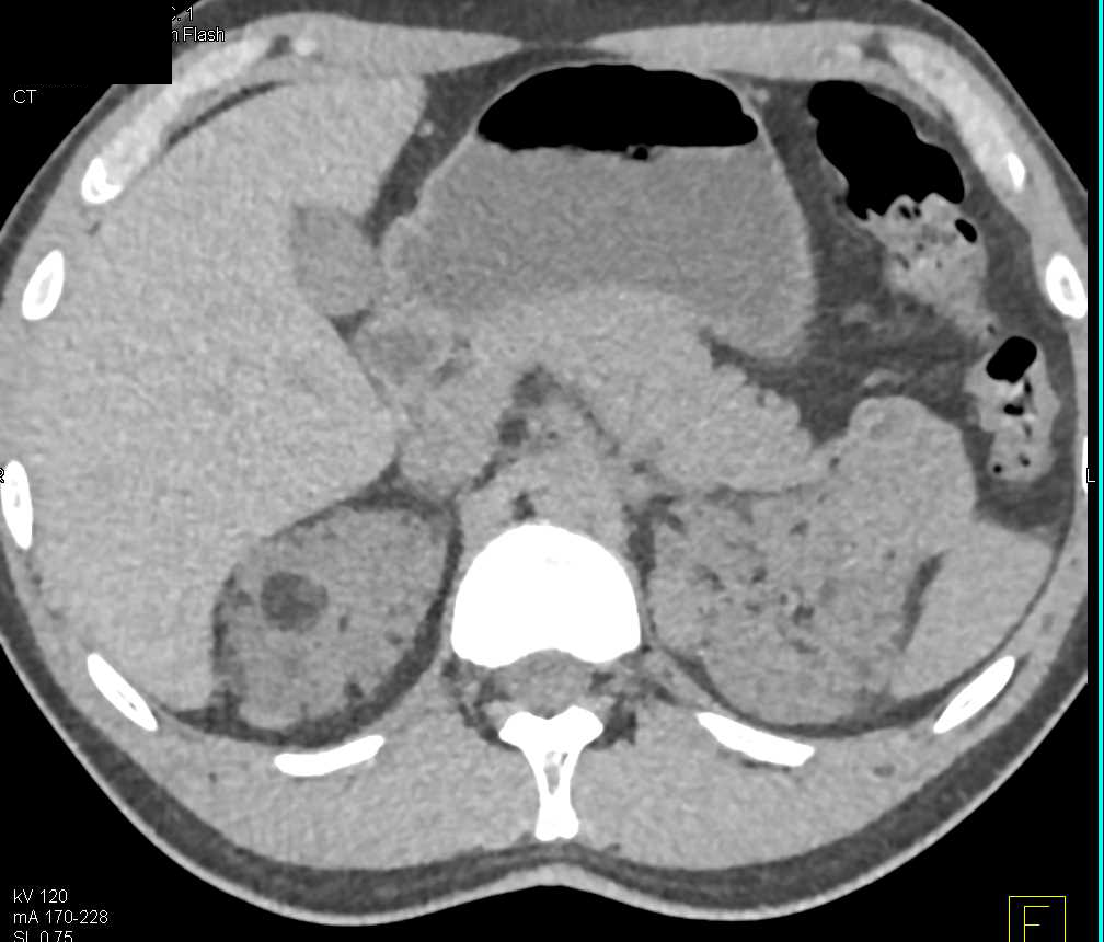 Multiple Bilateral Renal Angiomyolipomas in a Patient with Von Hippel-Lindau syndrome (VHL) - CTisus CT Scan