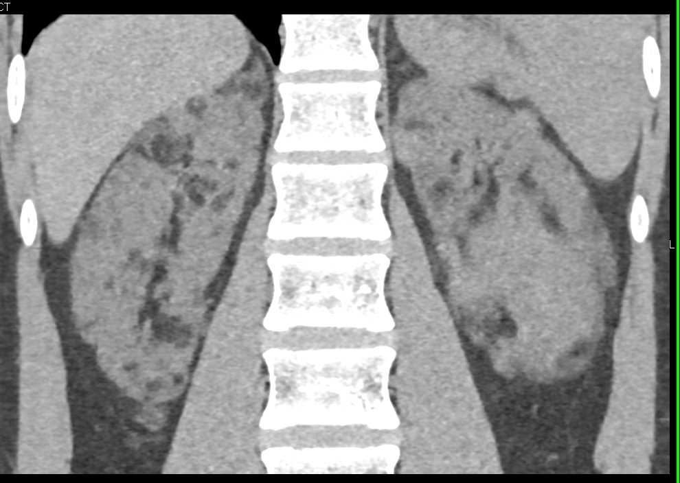 Multiple Bilateral Renal Angiomyolipomas - CTisus CT Scan