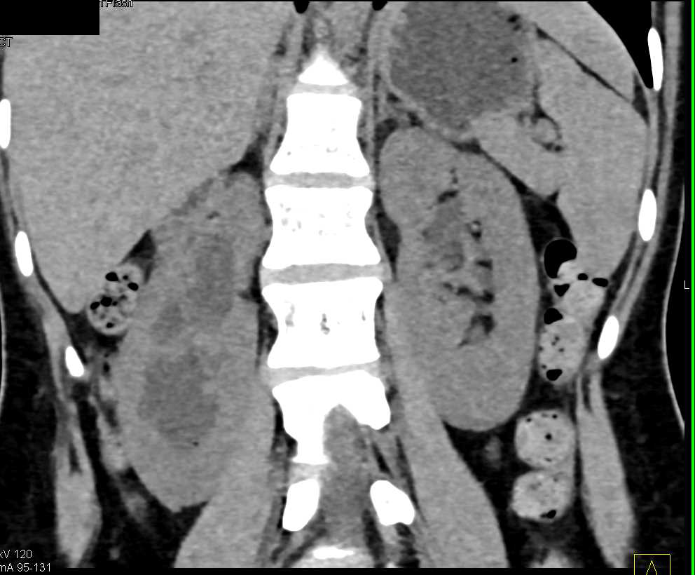 Dilated Right Renal Pelvis and Ureter - CTisus CT Scan