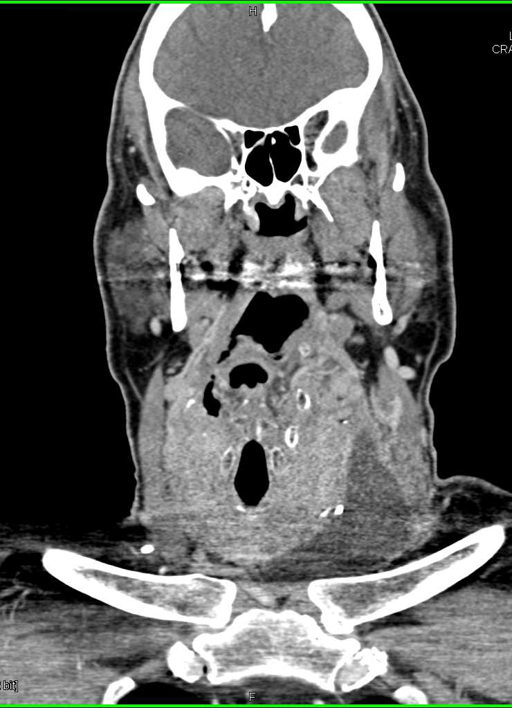 Renal Cell Carcinoma Metastatic to Right Adrenal and Left Neck with CT post Neck Resection - CTisus CT Scan