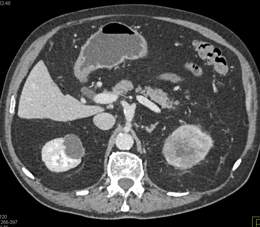 Left Renal Cell Carcinoma Invades the Left Renal Vein - CTisus CT Scan