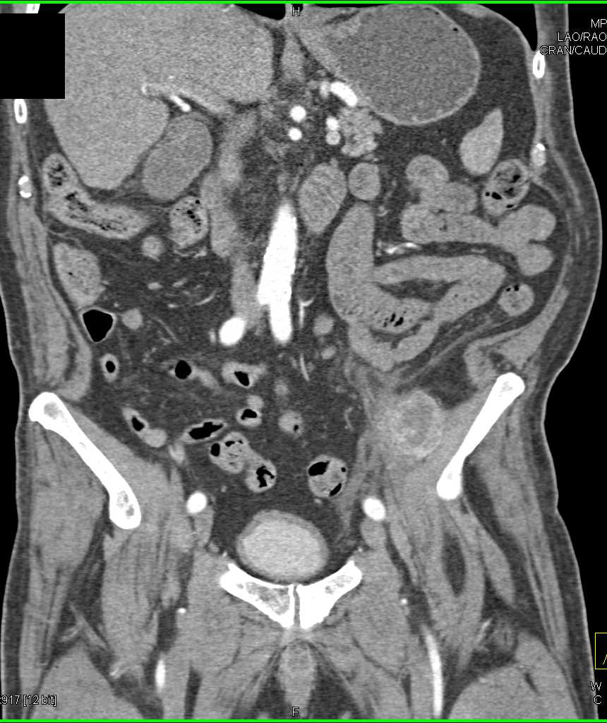 Metastatic Renal Cell Carcinoma to Muscle - CTisus CT Scan