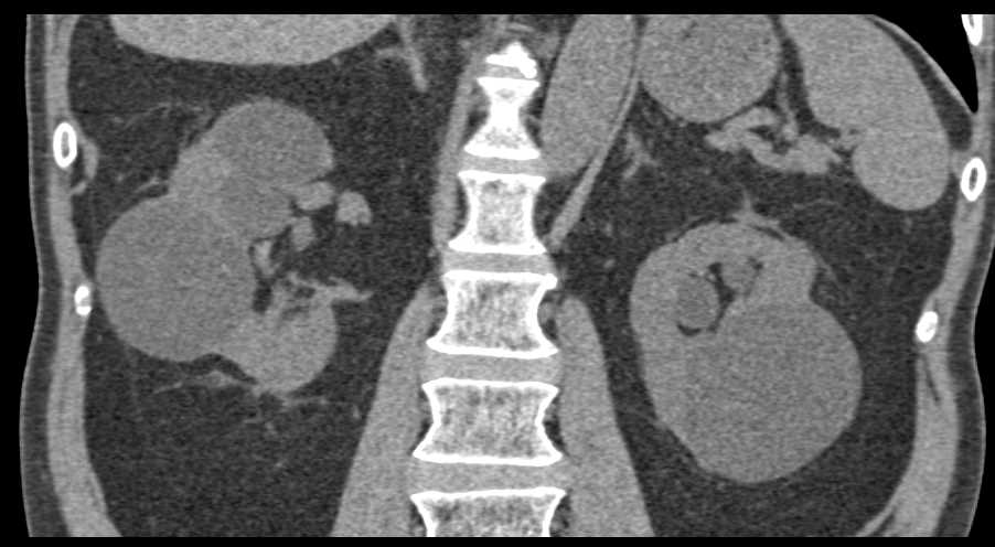 Bilateral Renal Cysts and Carcinoma of the Distal Left Ureter - CTisus CT Scan