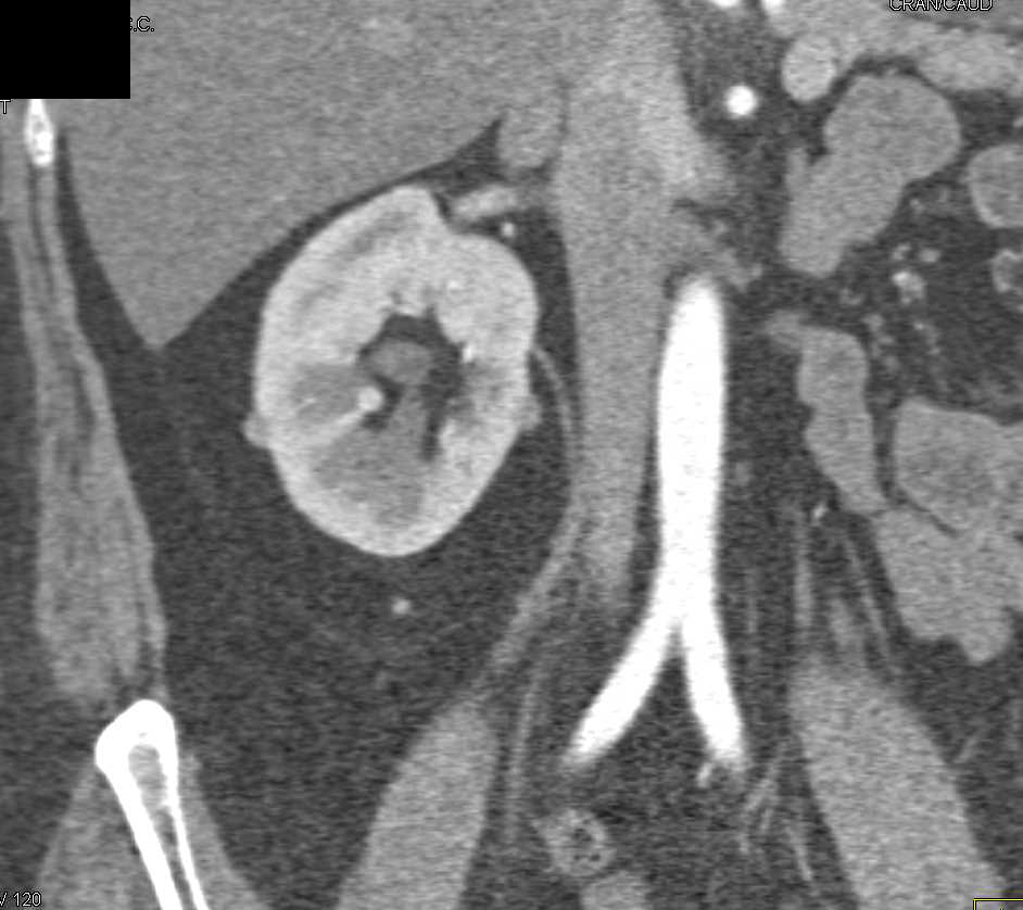 Several Under 1cm Right Renal Cell Carcinomas - CTisus CT Scan