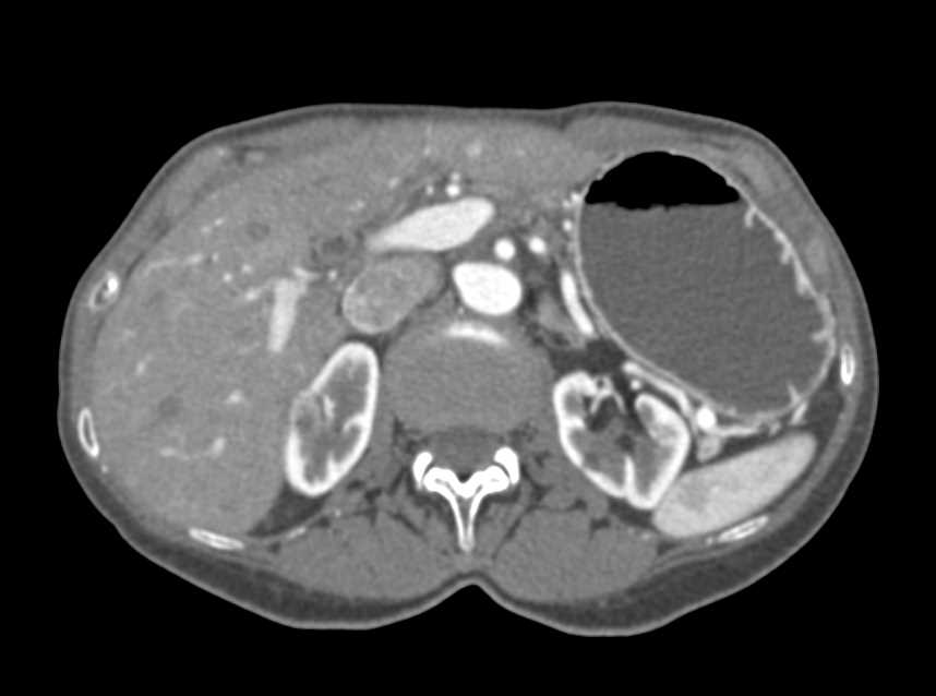 1cm Right Renal Cell Carcinoma - CTisus CT Scan