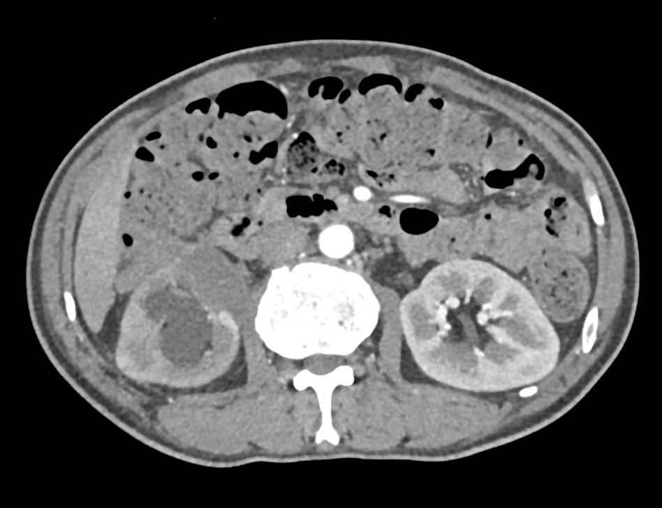Transitional Cell Carcinoma Right Renal Pelvis and Liver Metastases - CTisus CT Scan