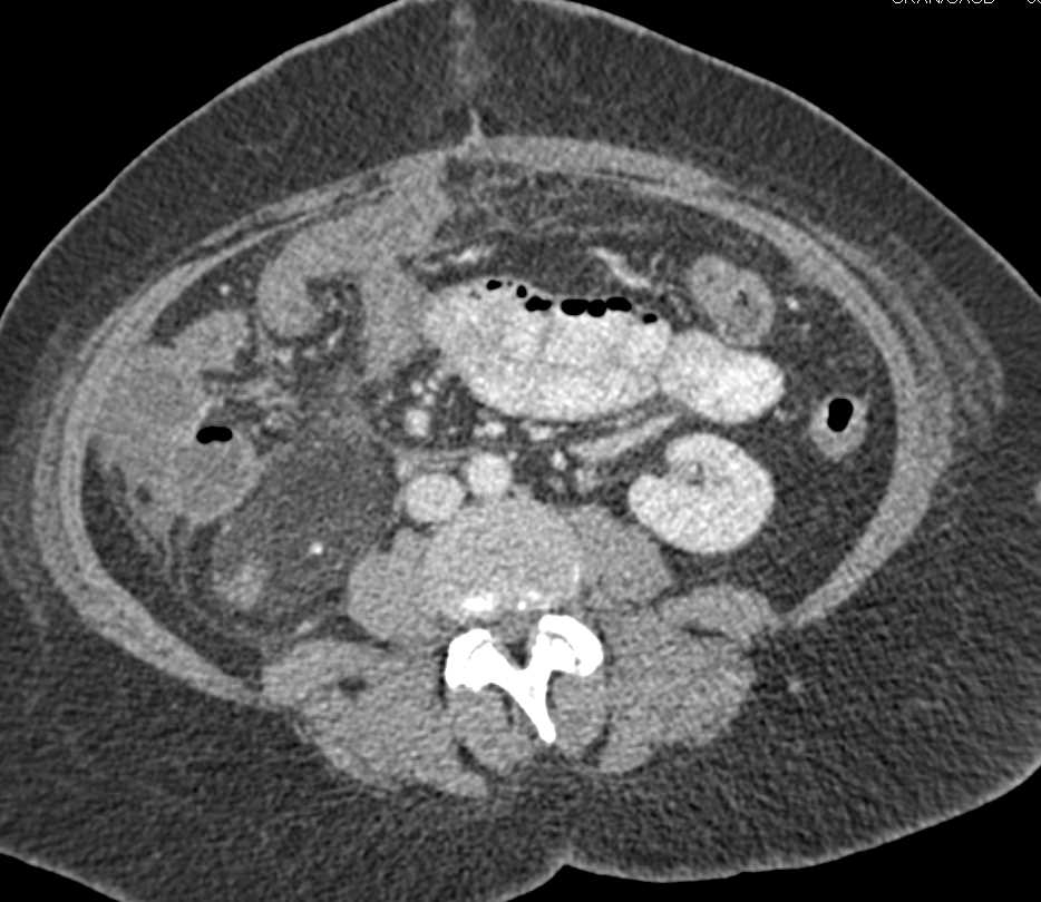 Angiomyolipoma Lower Pole of Right Kidney - CTisus CT Scan