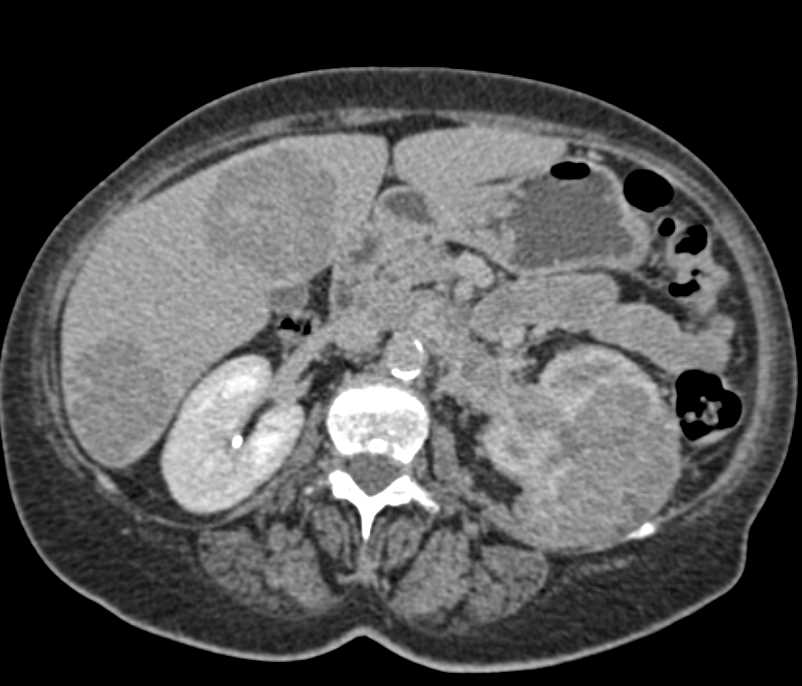Renal Cell Carcinoma with Renal Vein and Inferior Vena Cava (IVC) Invasion with Liver Metastases - CTisus CT Scan