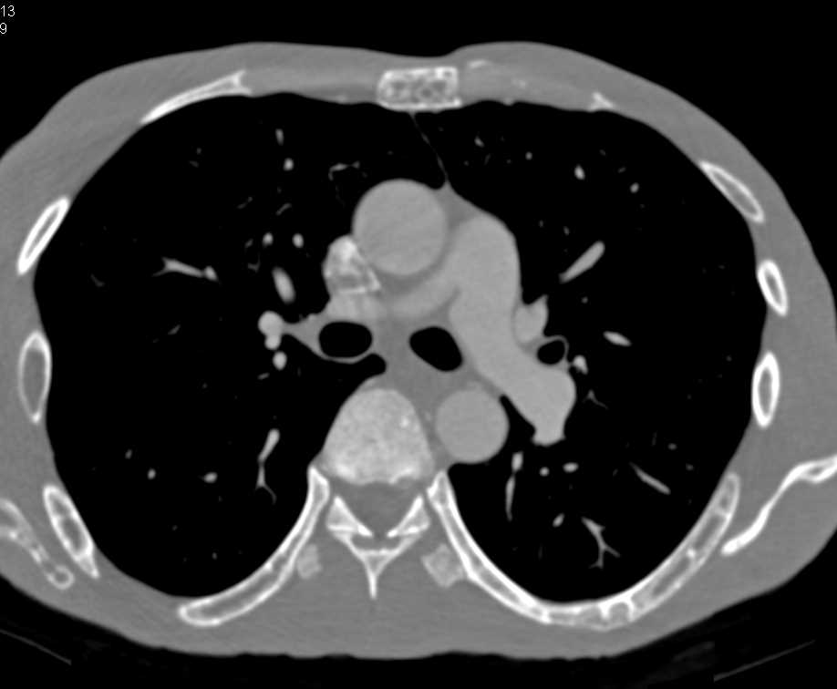 Renal Osteodystrophy with End Stage Renal Disease (ESRD) - CTisus CT Scan