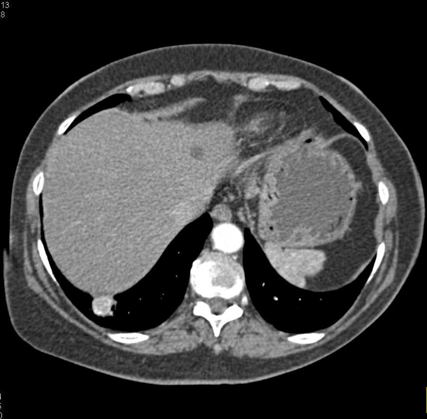 Renal Cell Carcinoma Involves the Renal Vein and Inferior Vena Cava (IVC) - CTisus CT Scan