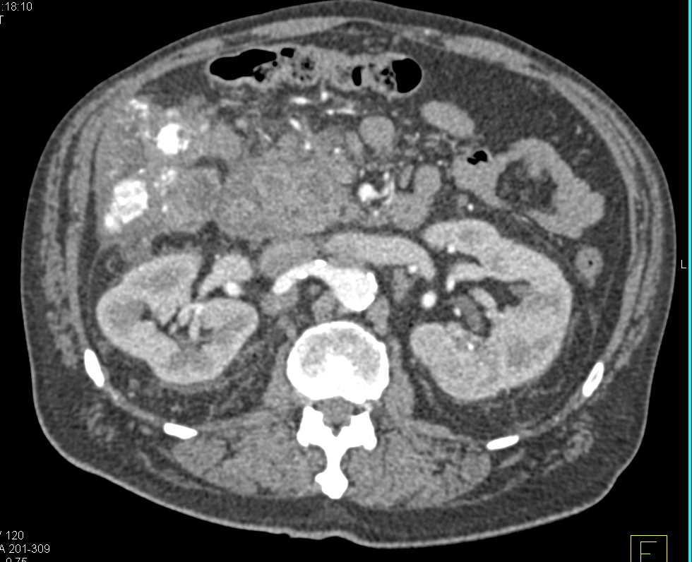 Renal Cell Carcinoma with Neovascularity - CTisus CT Scan