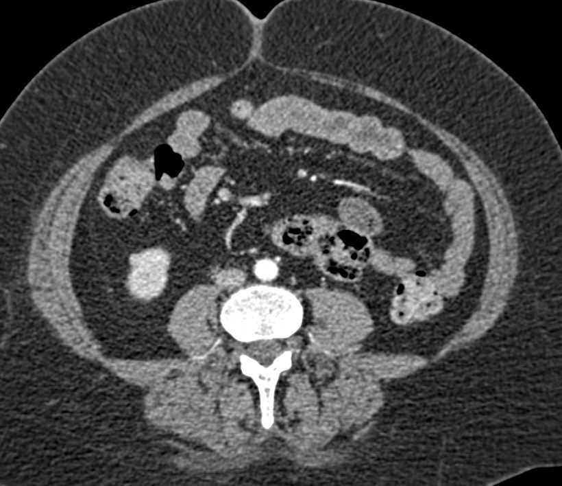 Several Under 1cm Right Renal Cell Carcinomas - CTisus CT Scan