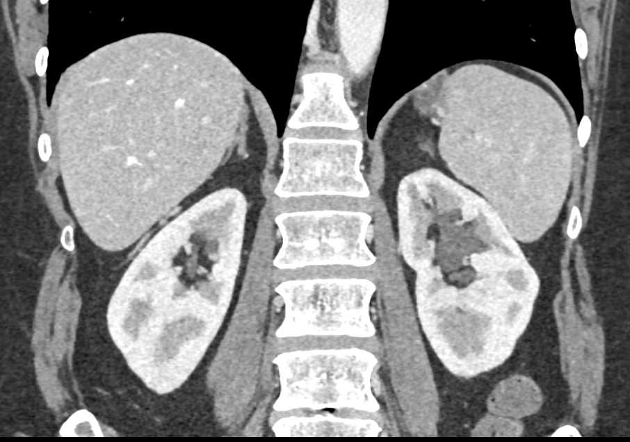 Dilated Calyx Upper Pole Left Kidney - CTisus CT Scan