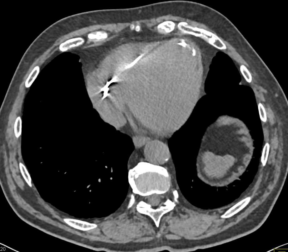 Transitional Cell Carcinoma Left Ureter with Stent in Place. Prior LV Infarct also seen - CTisus CT Scan