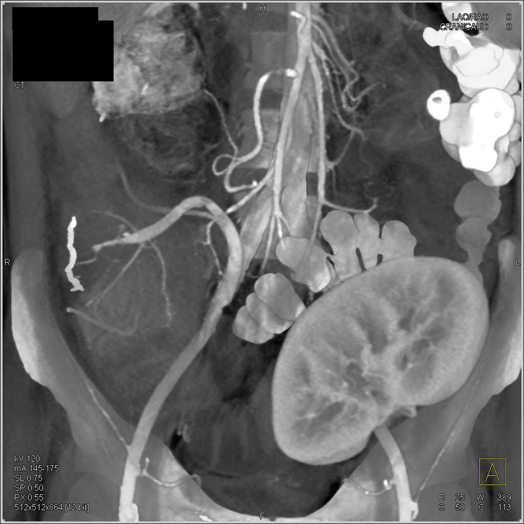 Pancreatic and Renal Transplant with Pancreatitis Around Pancreatic Transplant in Right Lower Quadrant - CTisus CT Scan