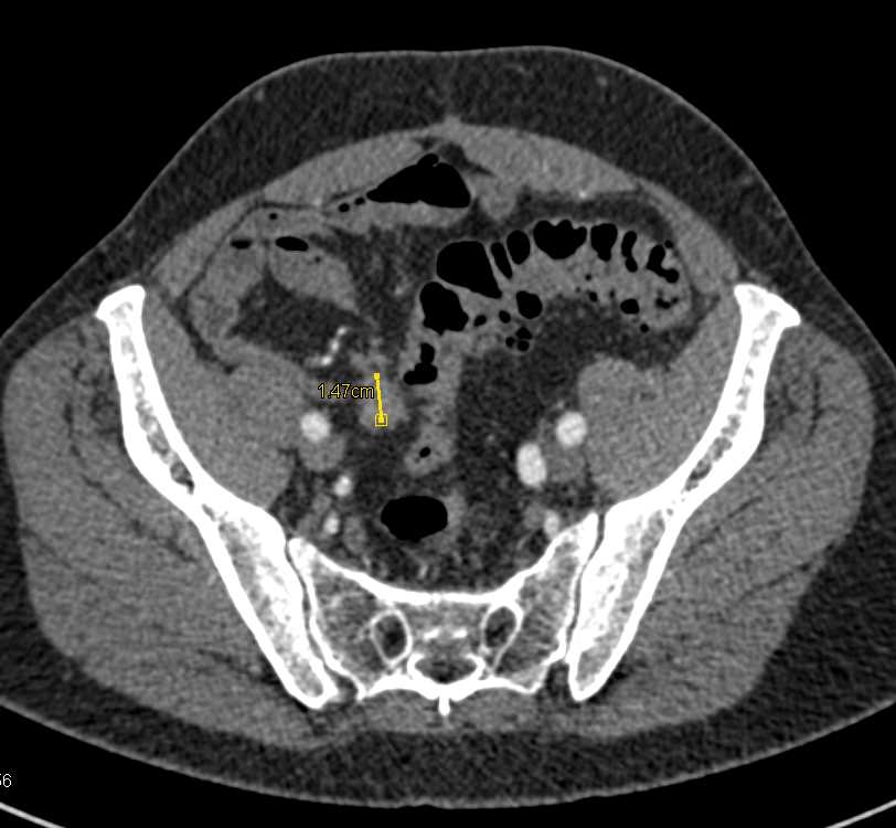 Transitional Cell Carcinoma Right Ureter with Mass Defined - CTisus CT Scan