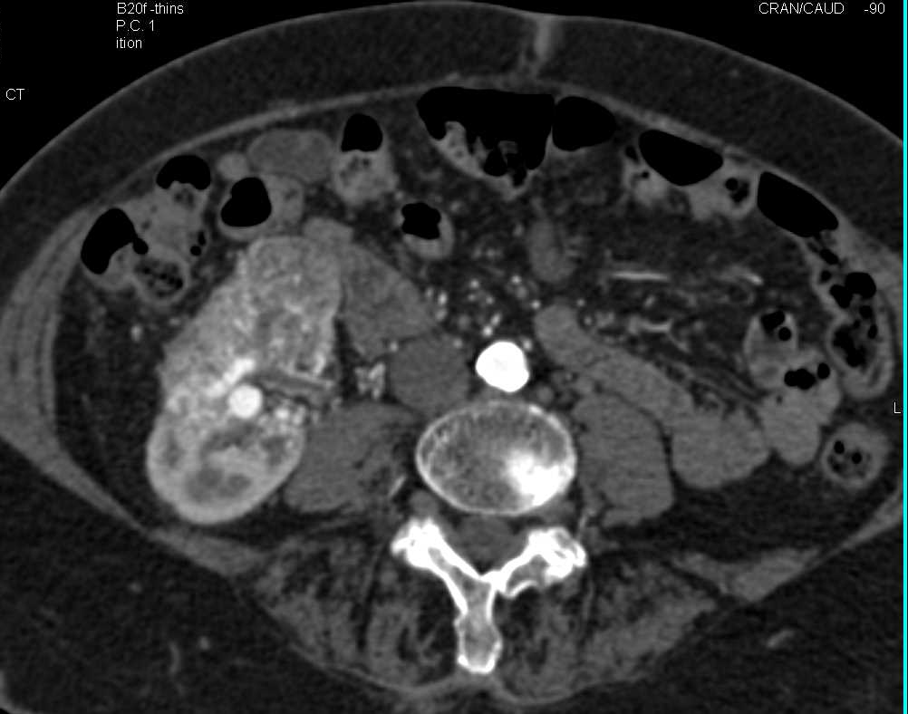Clear Cell Renal Cell Carcinoma - CTisus CT Scan