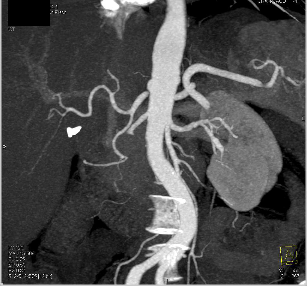 Fibromuscular Dysplasia of the Renal Arteries (FMD) - CTisus CT Scan