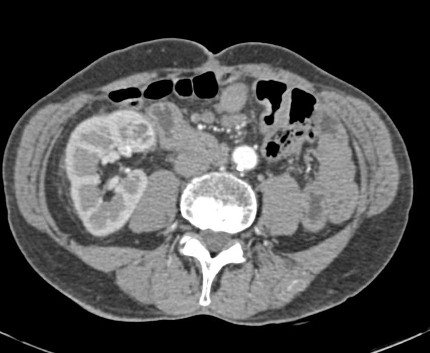 2 cm Right Renal Cell Carcinoma - CTisus CT Scan