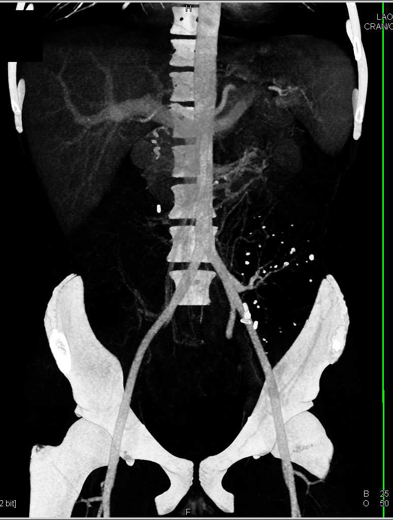 CTA of Failed Left Renal Transplant - CTisus CT Scan