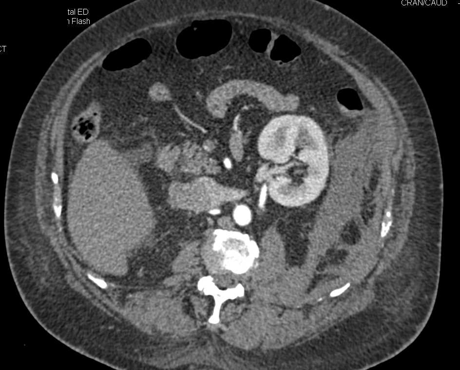 Infiltrating Renal Cell Carcinoma Right Kidney and Large Bleed Near Left Kidney - CTisus CT Scan