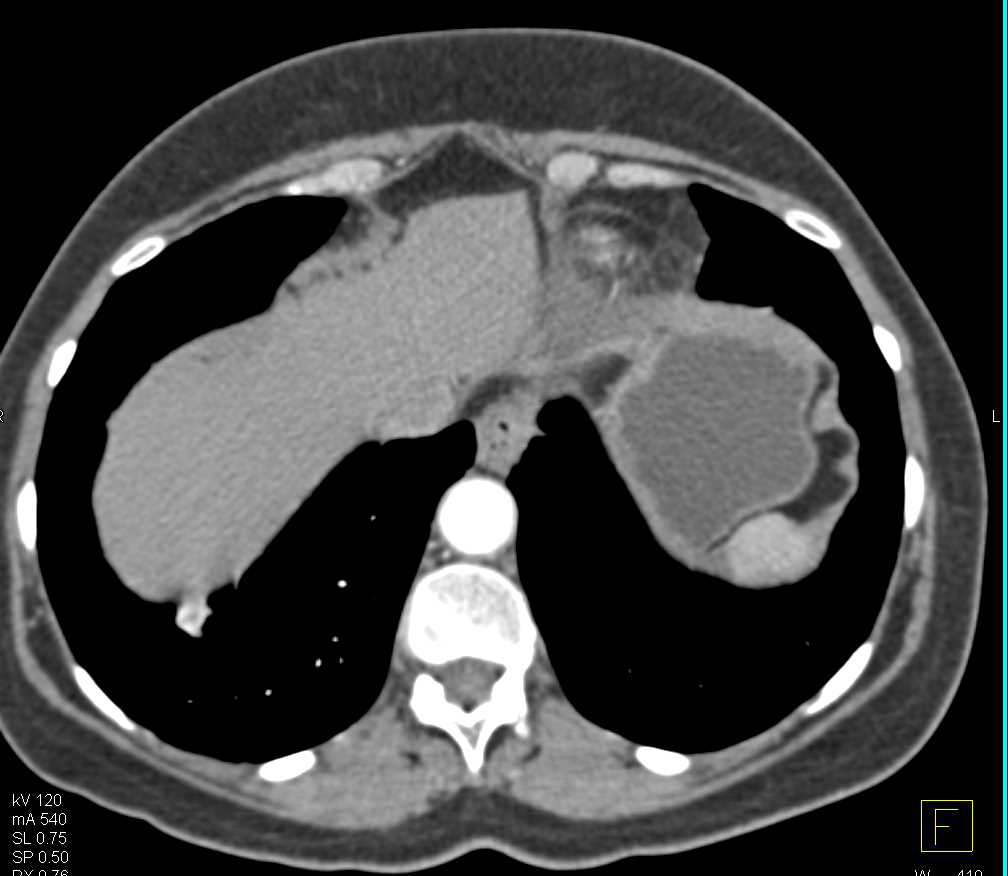 Right Nephrectomy with Recurrent Renal Cell Carcinoma - CTisus CT Scan