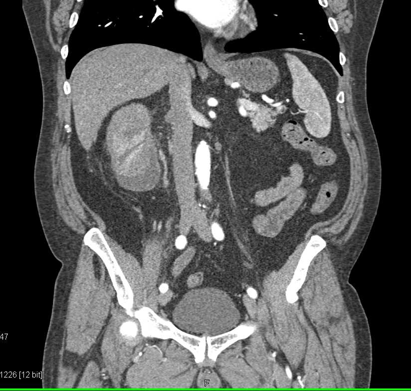 Infiltrating Renal Cell Carcinoma Right Kidney with Renal Vein Involvement - CTisus CT Scan