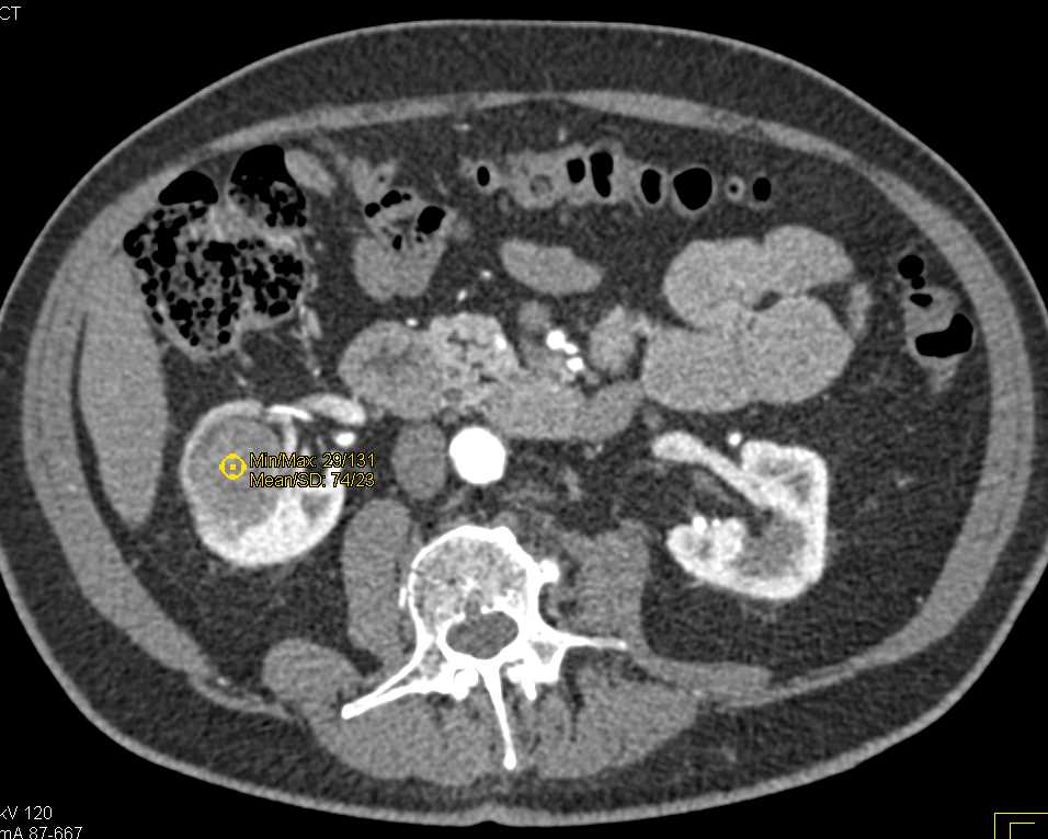 Cystic Right Renal Cell Carcinoma - CTisus CT Scan