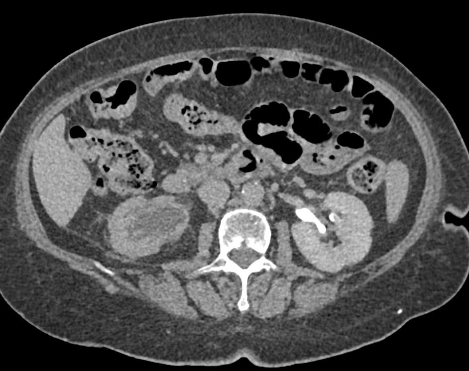 Transitional Cell Carcinoma of the Right Ureter and Bladder - CTisus CT Scan