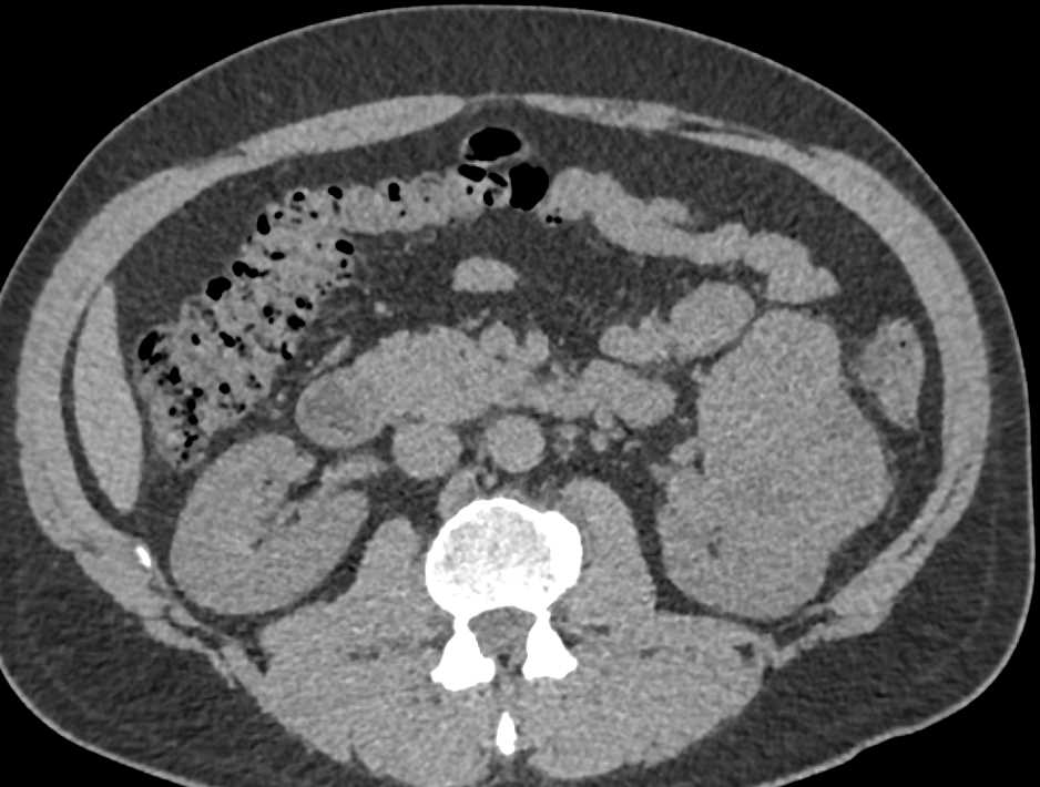 Multiphase Imaging of Clear Cell Renal Cell Carcinoma - CTisus CT Scan