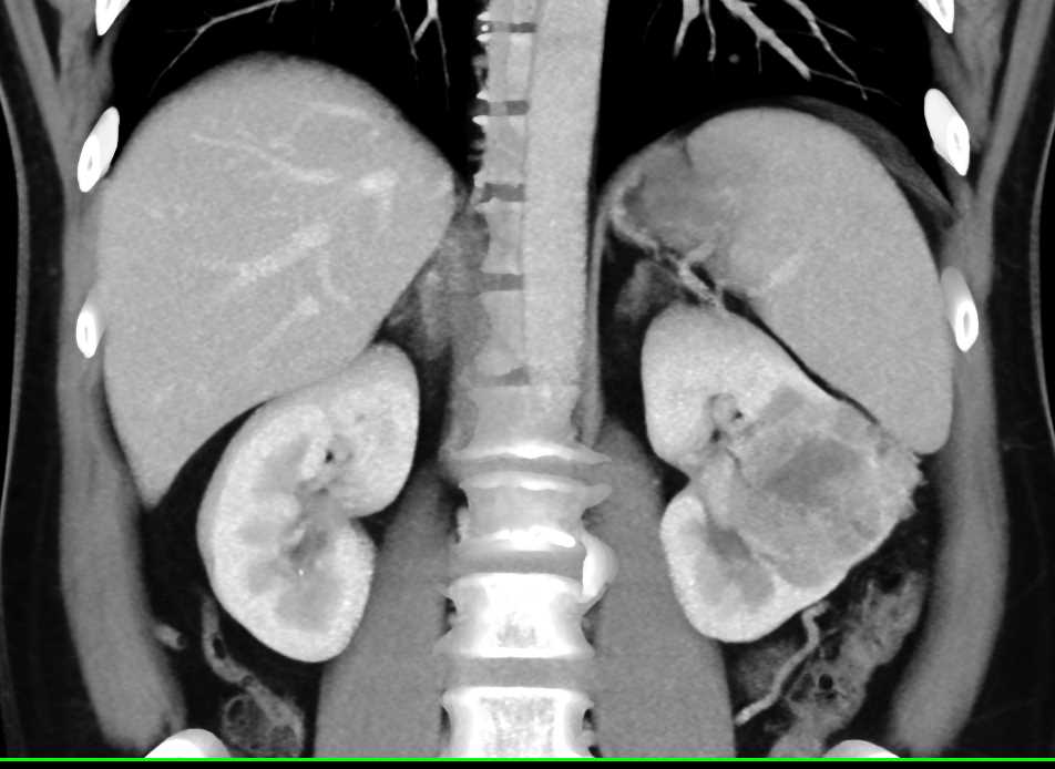 Multiphase Imaging of Clear Cell Renal Cell Carcinoma - CTisus CT Scan