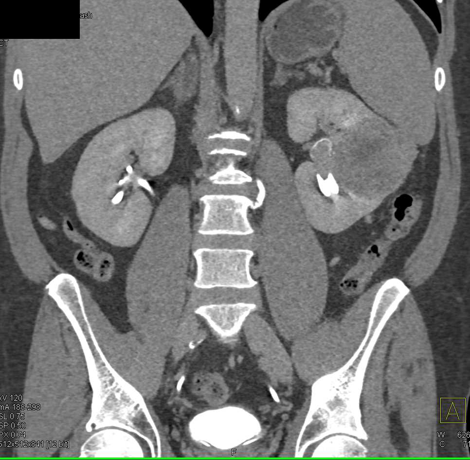 Multiphase Imaging of Clear Cell Renal Cell Carcinoma which Invades the Renal Pelvis - CTisus CT Scan