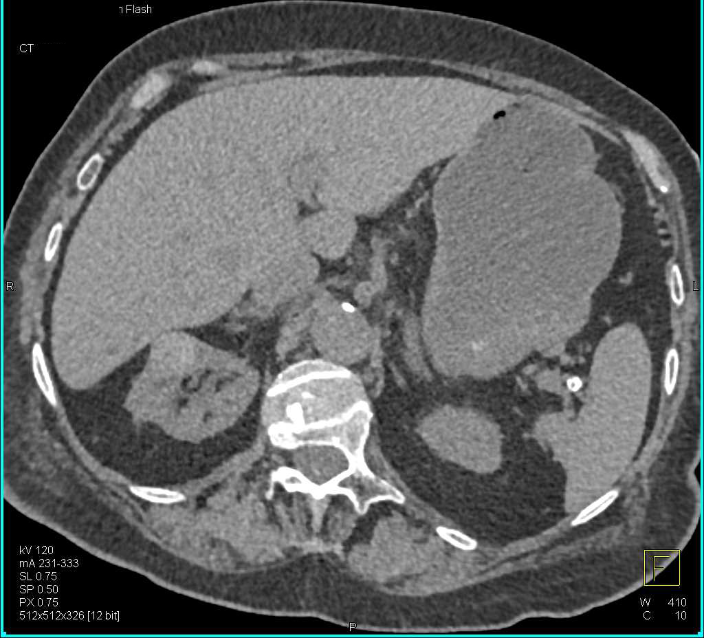 High Density Renal Cyst Right Kidney - CTisus CT Scan