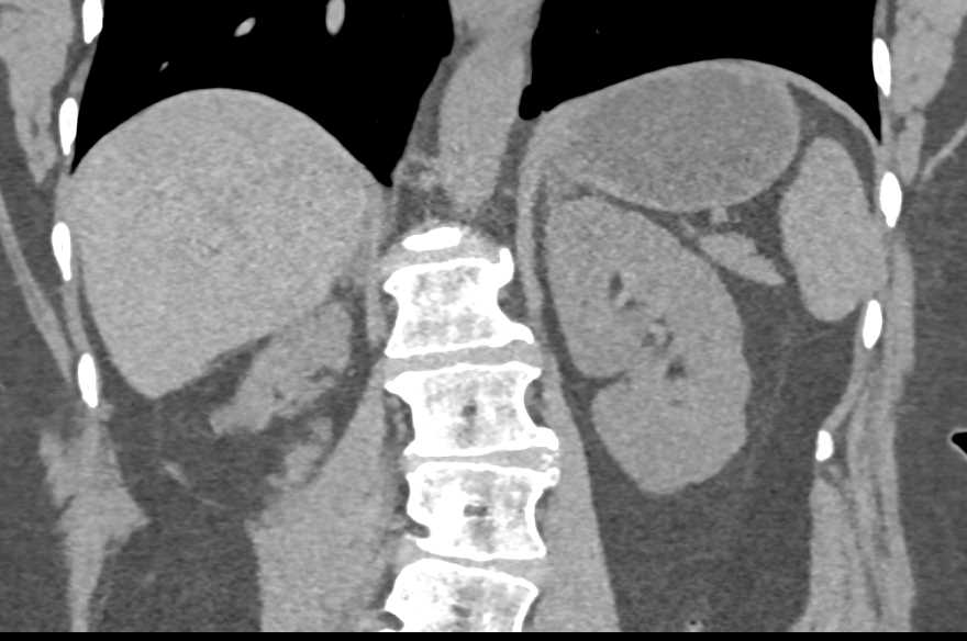 Scarring Right Kidney with Subtle Filling Defects in Right Ureter - CTisus CT Scan