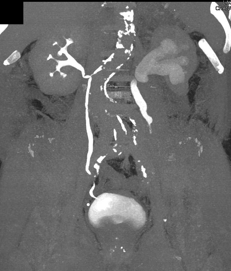 Transitional Cell Carcinoma Left Ureter - CTisus CT Scan