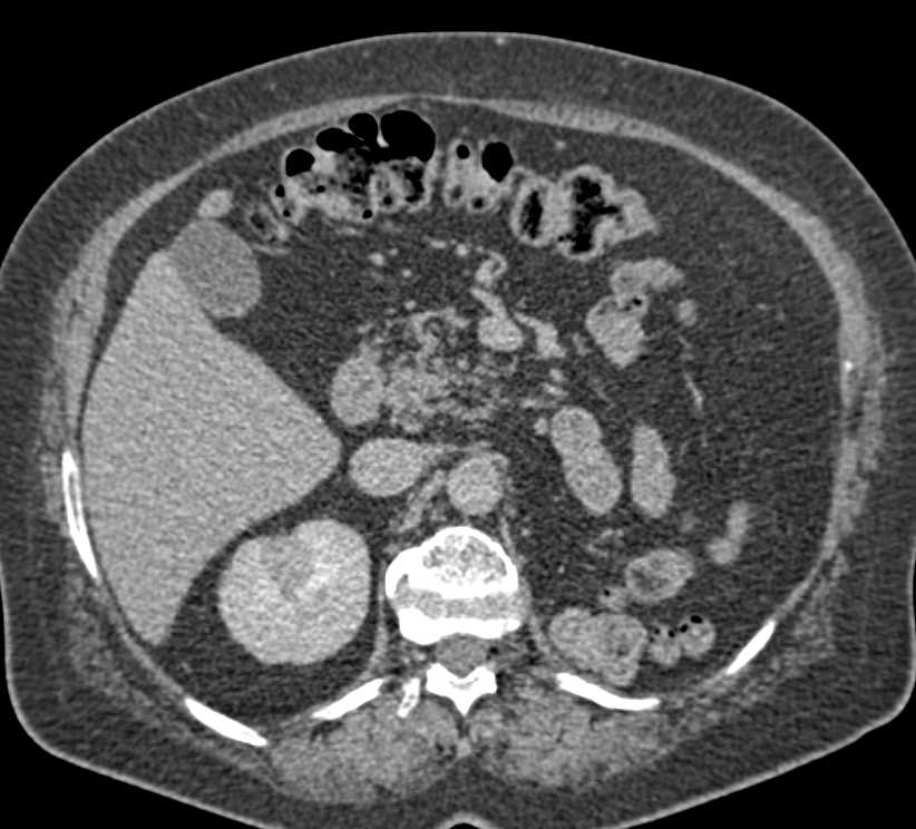 Left Nephrectomy with Recurrence in the Contralateral Kidney - CTisus CT Scan