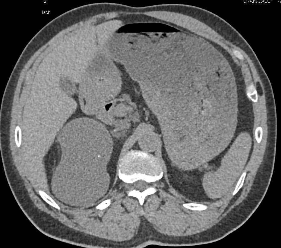 Bosniak 2F Cyst Right Kidney - CTisus CT Scan