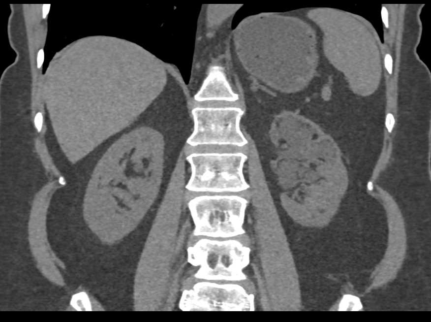 Dilated Calyces Upper Pole Left Kidney with Loss of Cortex - CTisus CT Scan