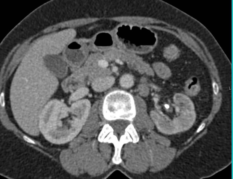 Bladder Cancer at the Left Ureterovesical Junction (UVJ) with Atrophic Left Kidney - CTisus CT Scan